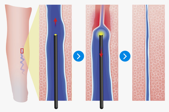 하지정맥류 레이저 치료