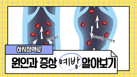 [하지정맥류] 종아리 핏줄과 통증 증상, 하지정맥류 예방법