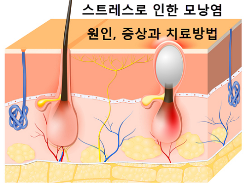 스트레스로 인한 모낭염, 여드름처럼 짜면 안돼요 | 원인과 증상, 치료방법