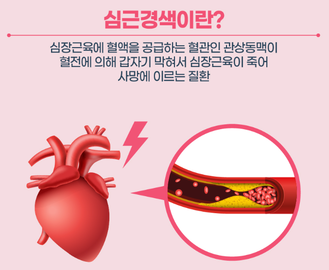 심근경색 원인과 증상 및 진단 치료와 예방하기